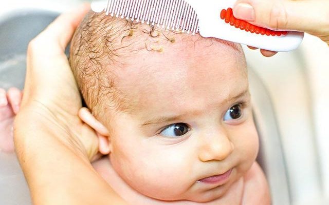 First-time Mom? Learn How to Deal With Cradle Cap