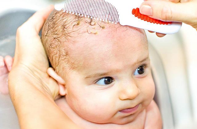 First-time Mom? Learn How to Deal With Cradle Cap